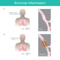 Bronchial Inflammation. Illustration.