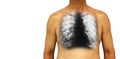 Bronchiectasis . Human chest with x-ray chest show multiple lung bleb and cyst due to chronic infection . Isolated background . B Royalty Free Stock Photo