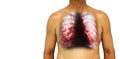 Bronchiectasis . Human chest with x-ray chest show multiple lung bleb and cyst due to chronic infection . Isolated background . B Royalty Free Stock Photo