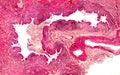 Bronchiectasis, light photomicrograph