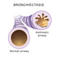 Bronchiectasis. Normal airway and asthmatic airway Royalty Free Stock Photo