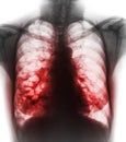 Bronchiectasis . X-ray chest show multiple lung bleb and cyst due to chronic infection . Front view