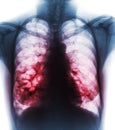 Bronchiectasis . X-ray chest show multiple lung bleb and cyst due to chronic infection . Front view