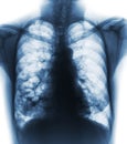 Bronchiectasis . X-ray chest show multiple lung bleb and cyst due to chronic infection . Front view Royalty Free Stock Photo