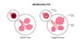 Bronchiolitis lung disease