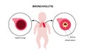 Bronchiolitis lung disease