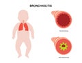 Bronchiolitis lung disease