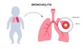 Bronchiolitis lung disease