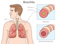 Bronchitis Affected Airways diagram medical