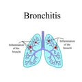 Bronchitis. The anatomical structure of the human