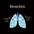 Bronchitis. The anatomical structure of the human lung. Vector illustration on a black background