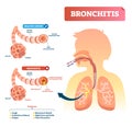 Bronchitis vector illustration. Lung disease diagnosis with symptoms.