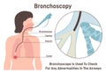 Bronchoscopy. Human respiratory system examination. flexible bronchoscopy