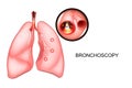 Bronchoscopy of the lungs, sectional view Royalty Free Stock Photo