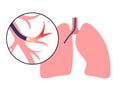 Bronchoscopy procedure concept