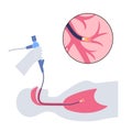 Bronchoscopy procedure concept