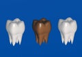 Brown affected tooth. 3d illustration