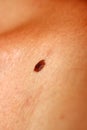 Brown birthmark. Brown mole large size. Stain on the skin Royalty Free Stock Photo