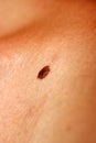 Brown birthmark. Brown mole large size. Stain on the skin