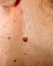 Brown birthmark. Brown mole large size. Stain on the skin Royalty Free Stock Photo