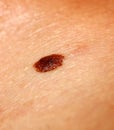 Brown birthmark. Brown mole large size. Stain on the skin Royalty Free Stock Photo