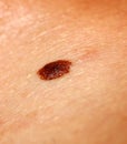 Brown birthmark. Brown mole large size. Stain on the skin