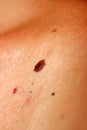 Brown birthmark. Brown mole large size. Stain on the skin Royalty Free Stock Photo