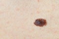 Brown birthmark (nevus) on Caucasian woman leg. Royalty Free Stock Photo