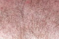 Brown and gray hair on the male chest. Red pimples on the very hairy menÃ¢â¬â¢s breast Royalty Free Stock Photo