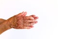 A brown hand with two silver rings of an elderly woman with Rheumatoid Arthritis disease.