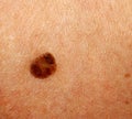 Brown spot on the skin. Birthmark on the body Royalty Free Stock Photo