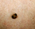 Brown spot on the skin. Birthmark on the body Royalty Free Stock Photo
