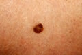 Brown spot on the skin. Birthmark on the body