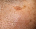 Brown spot on the skin of the face. Pigmentation on the skin