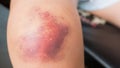 Bruise injury on knee