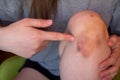 Bruise injury on young woman knee. Close up image of female person sitting on sofa and holding in hands wounded leg with