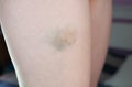 Bruise on the leg of a young woman. A bruised leg. Close-up Royalty Free Stock Photo