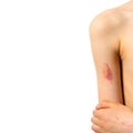 Bruise on the shoulder, bruising on the skin Royalty Free Stock Photo
