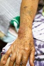 Bruise wounded skin texture of old asian woman right arm