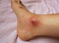 A bruised ankle after tripping over and twisting