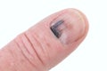 Bruised finger nail Royalty Free Stock Photo