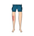 Front view of a bruised light skin leg illustration