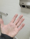 Bruised Palm Hand under Hand Dryer Royalty Free Stock Photo