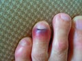 Bruised toe