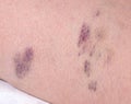 Bruises and thrombosis on the legs of a woman. Phlebeurysm, close-up, chronic