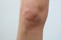 Bruises on the woman`s knee on white background