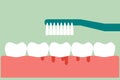 Brushing teeth with bleeding on gum and tooth concept gingivitis or scurvy