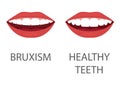 bruxism. grinding of teeth. tooth appliance. dental care. dentistry health problem