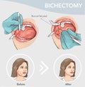 Buccal Fat Pad Removal Before and after vector illustration