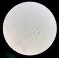 Budding yeast cells with pseudohyphae in urine sample